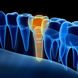 Dental Implant service in Dubai