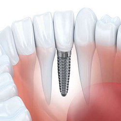 Oral Surgery service in Dubai