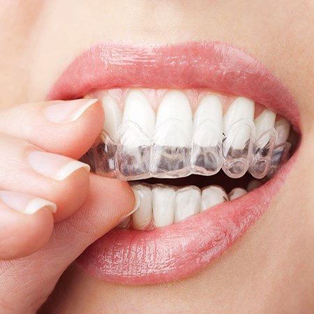 Invisalign Treatment in Dubai